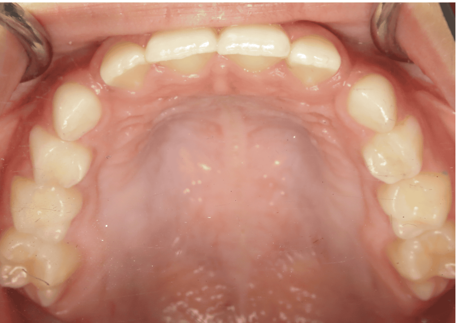 Interior view of a mouth showing upper teeth and the palate, which is pink.