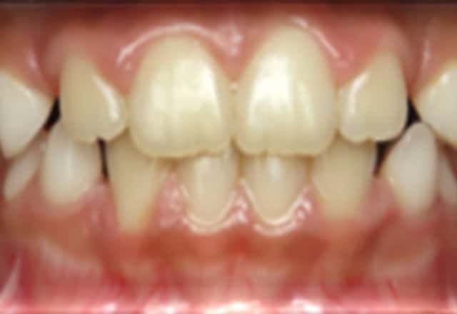 Close-up of a person's teeth, showing front teeth and canines, slightly misaligned and pale yellow in color.