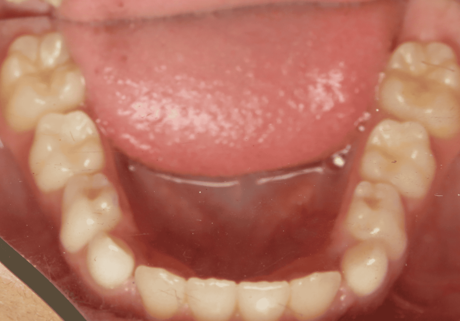 Interior view of lower teeth, showing molars and incisors. Pink gums and tongue are visible.