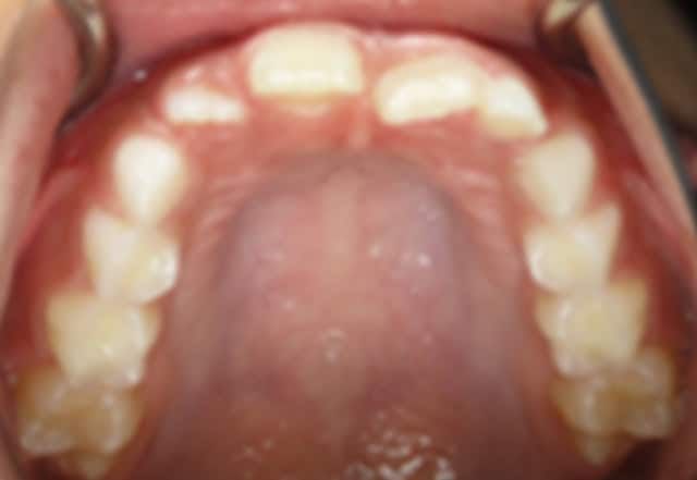 Inside a child's mouth, showing the upper teeth and palate, with pink gums.