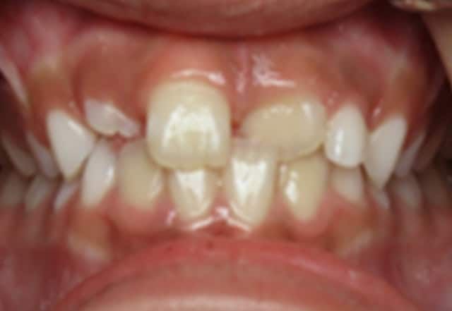 Close-up of a child's teeth, showing crowding and a large gap between the two front teeth.