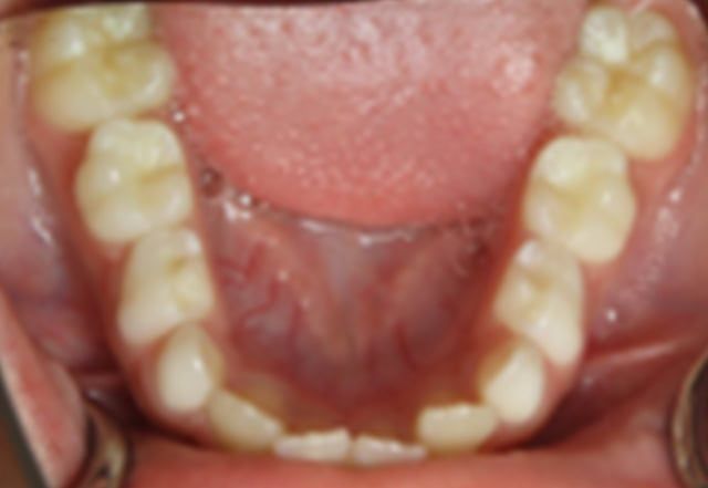 Inside view of a mouth showing the lower teeth, tongue, and gums. The teeth are white and the gums are pink.