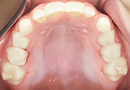 Inside view of a mouth showing upper teeth, including molars and incisors. Pink palate visible.