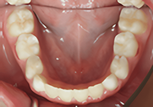 Inside view of the bottom row of teeth in a person's mouth, showing molars and incisors with pink gums.