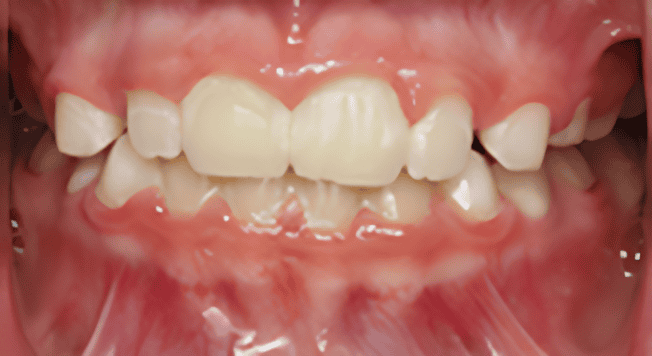 Close-up of a child's teeth, showing crowding and misalignment. Pink gums are visible.