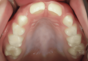 Top-down view of a child's upper teeth. The teeth are white, and the gums are pink.