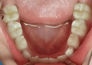 Mouth interior with lower retainer. Molars and incisors are visible, tongue in the center.