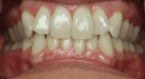 Close-up of a person's teeth. White teeth, pink gums, and slightly misaligned.