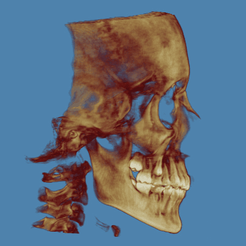 3D rendering of a human skull, viewed from the side, revealing bone structure in shades of brown against a blue background.