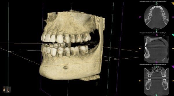 3D dental scan of a jaw showing teeth and bone, with cross-sectional views on the right.