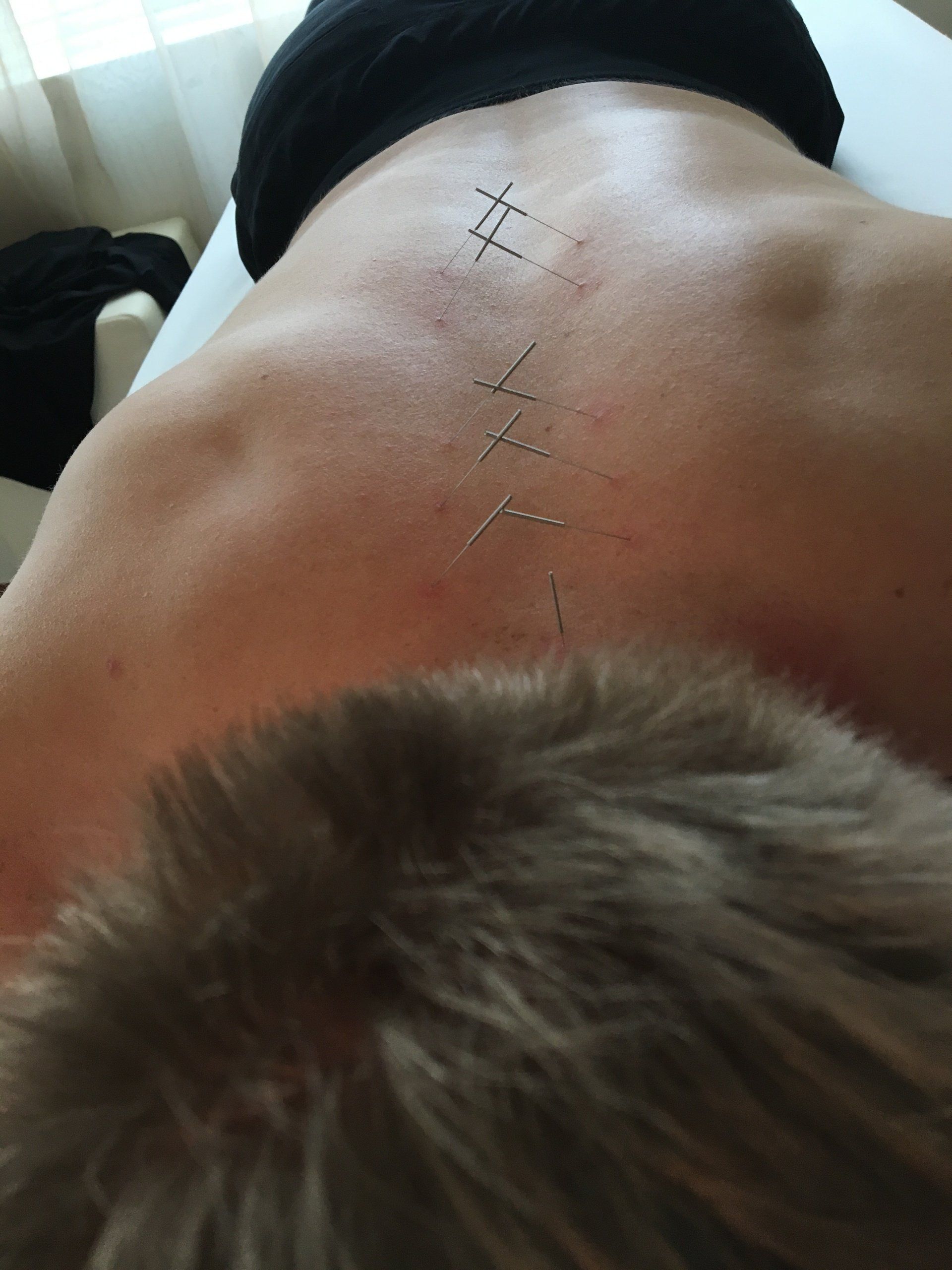 Acupuncture needles on the back of Xander Clemens