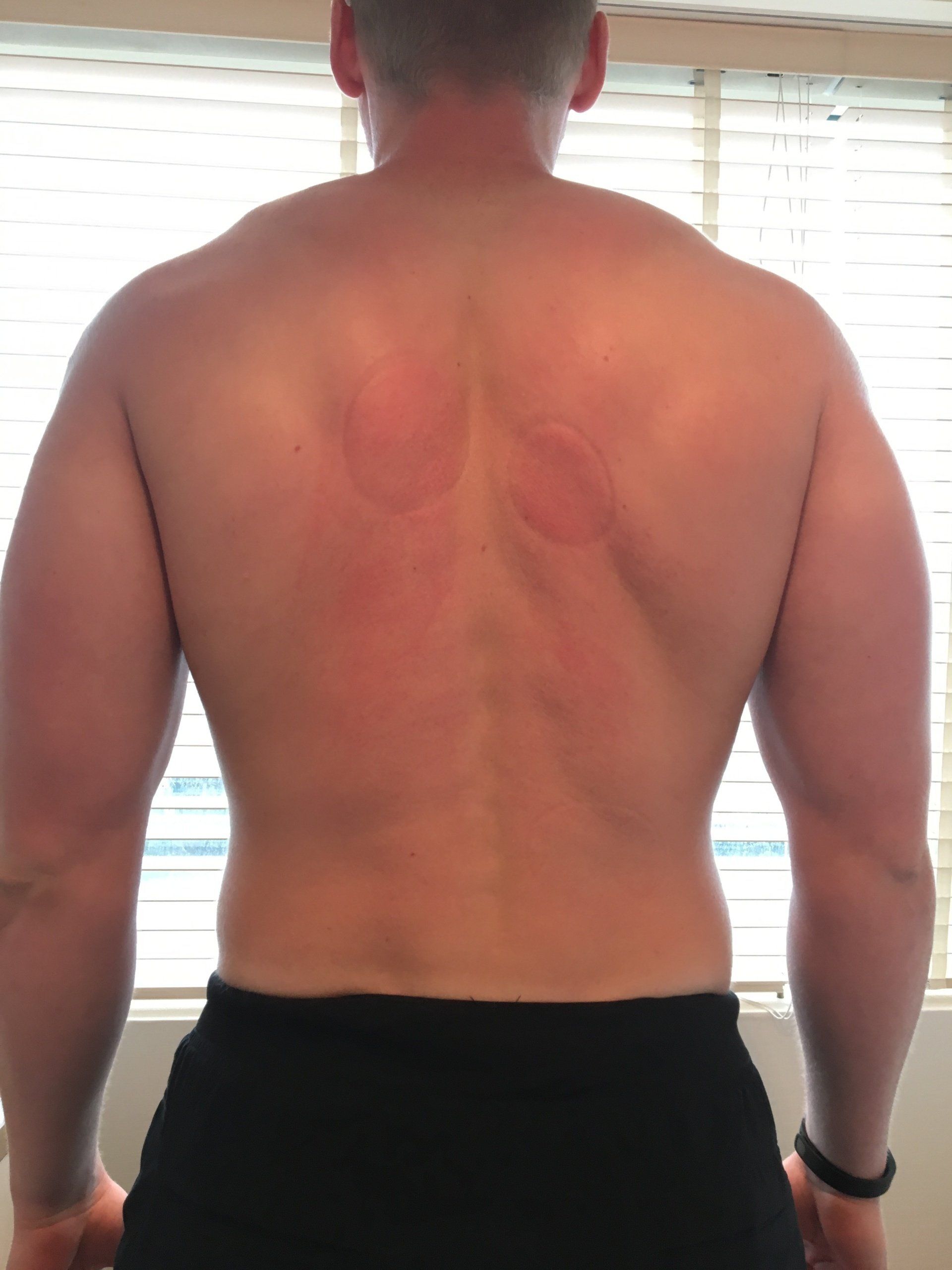 Xander Clemens after photo of his cupping service performed by Reiko Mitani on the Seabourn Quest