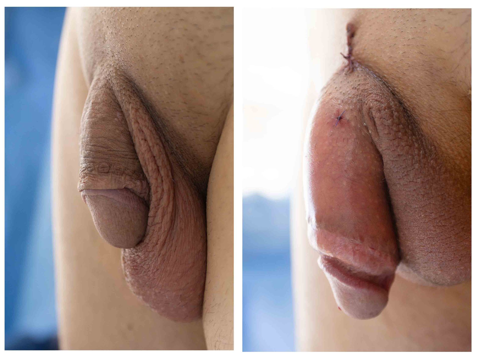 penis enlargement surgery