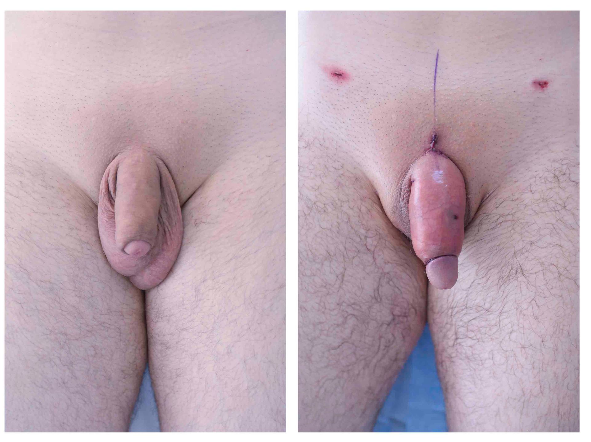 penis enlargement surgery