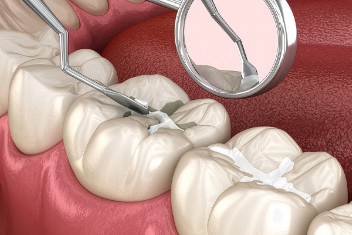 Sealants
