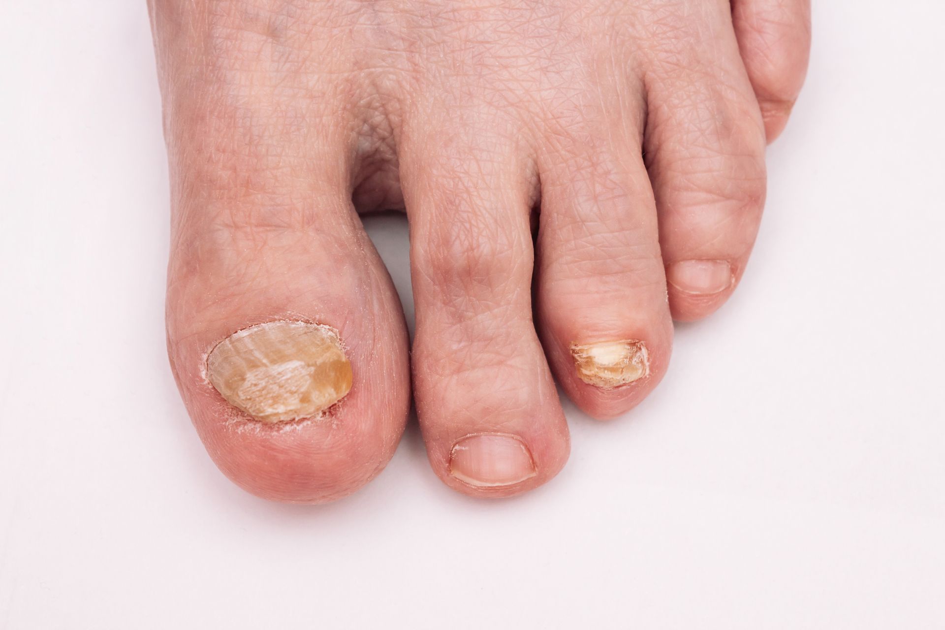 A close up of a person 's foot with a toenail infection.