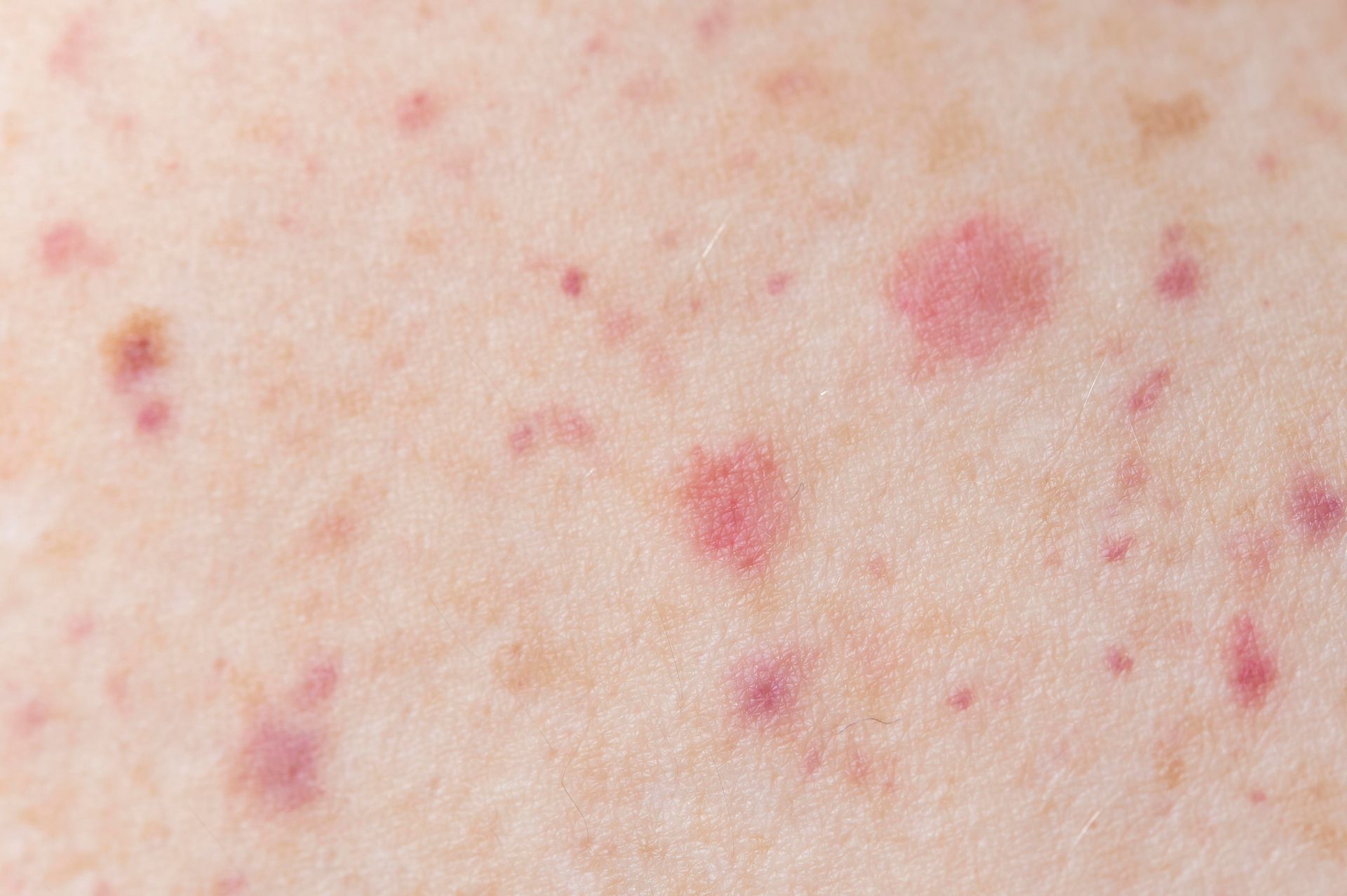 A close up of a person 's skin with red spots on it.