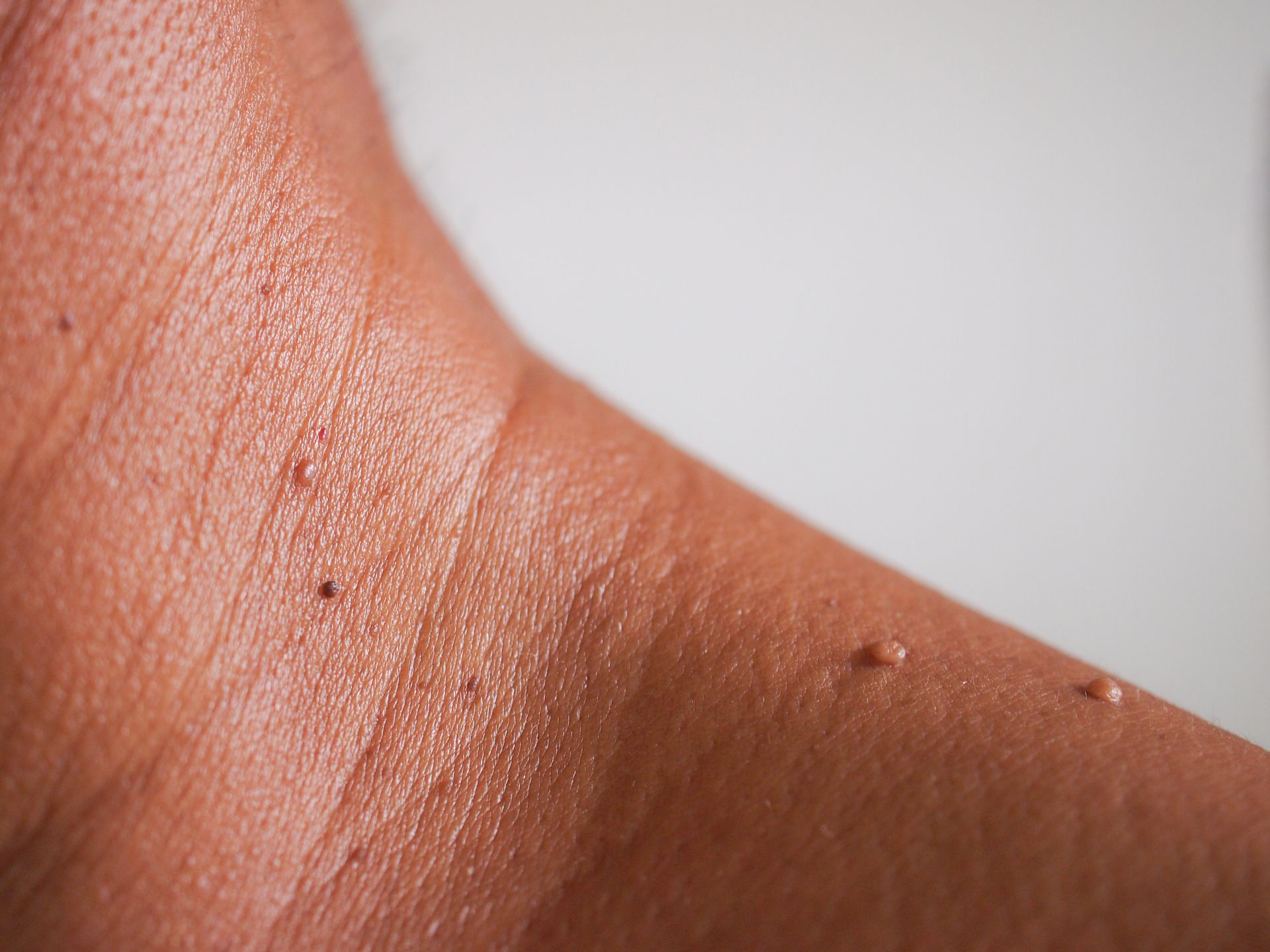 A close up of a person 's wrist with warts on it.