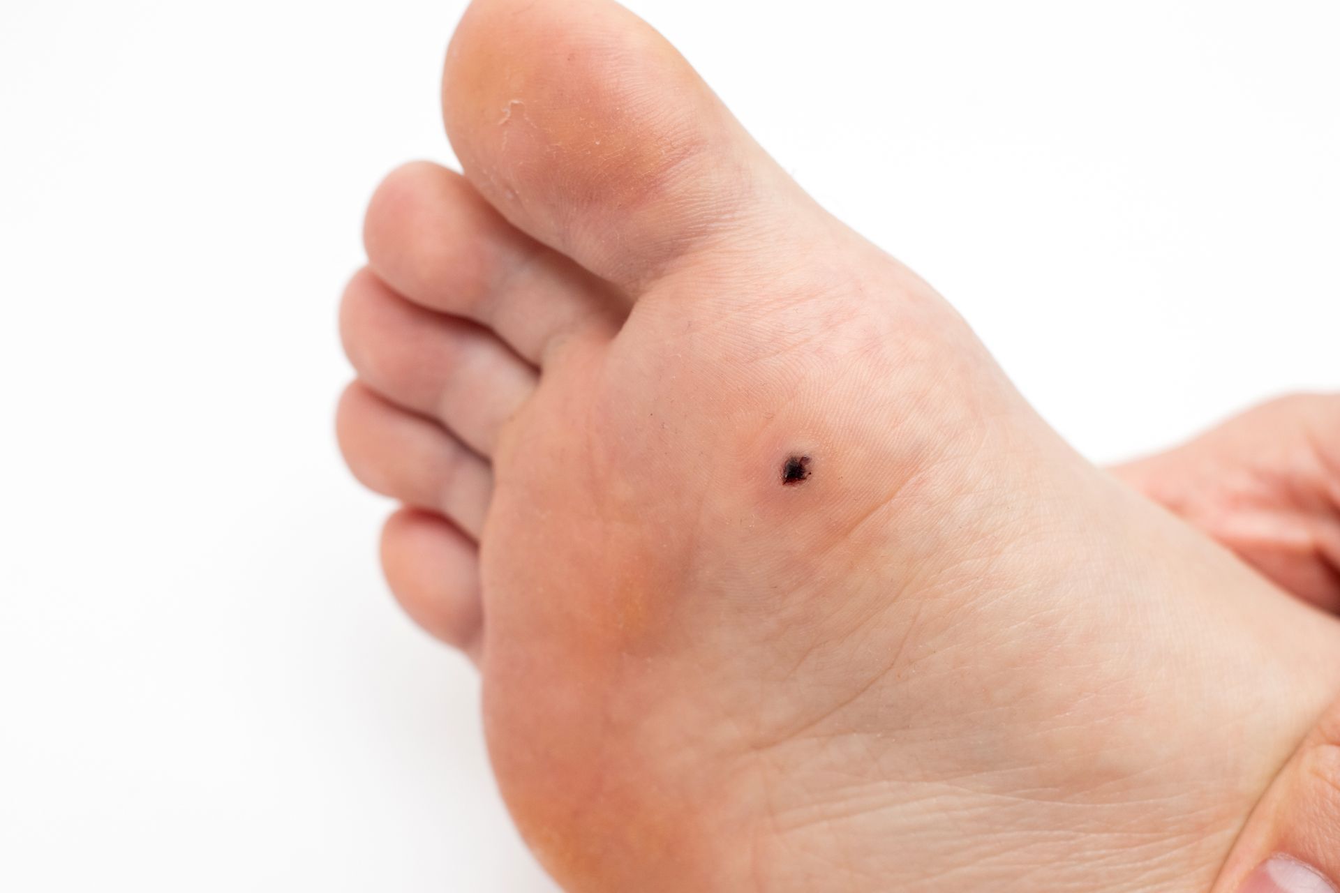 A close up of a person 's foot with a black spot on it.