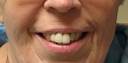 A close up of a woman's mouth with white teeth.
