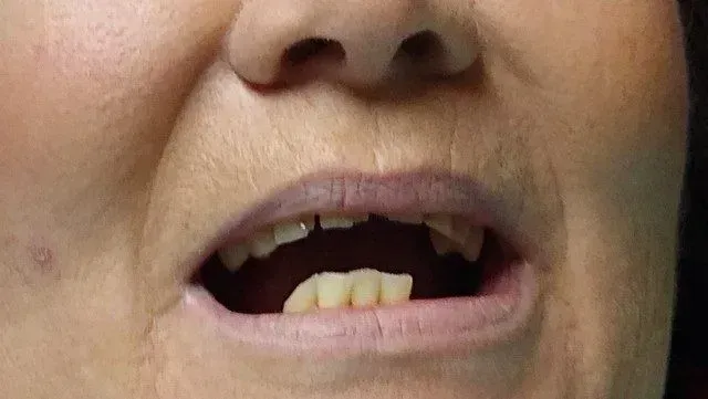 A close up of a woman's mouth with missing teeth.