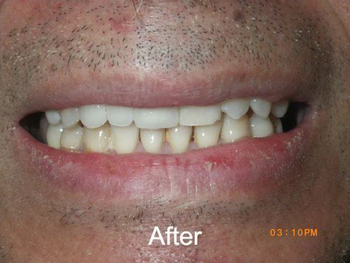 Patient after Dental Bridge