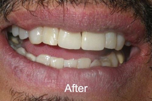 After Dental Implants