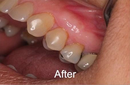 After Gum Grafts at Aurora Dental Care