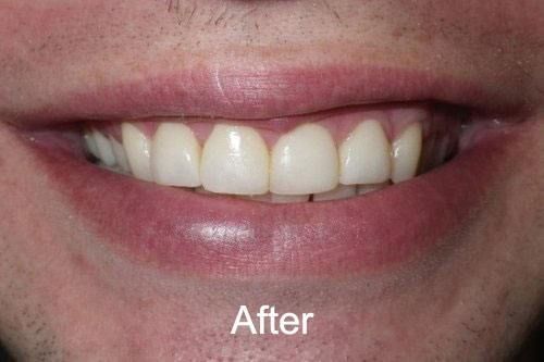 After Veneers at Aurora Dental Care