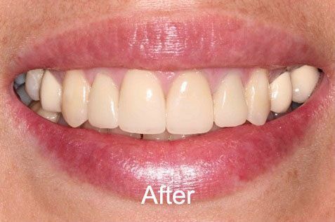 After crowns and fillings Aurora Dental Care