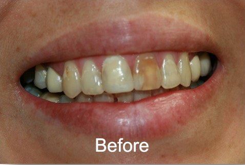 Patient Before crowns and cleanings at Aurora Dental Care