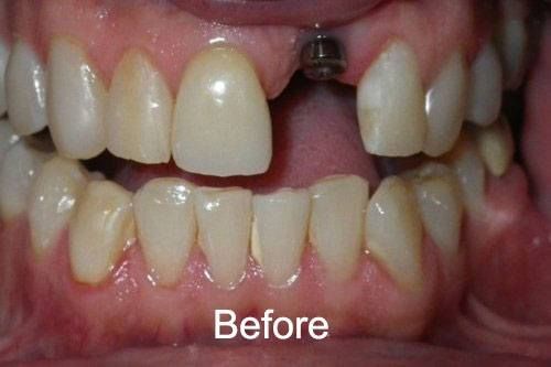 Before Dental Implants