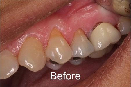 Before Gum Grafts at Aurora Dental Care