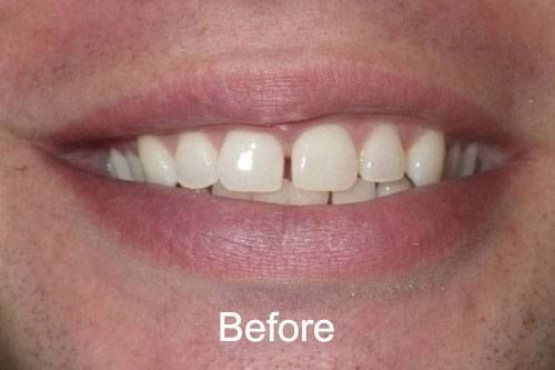 Before Veneers at Aurora Dental Care