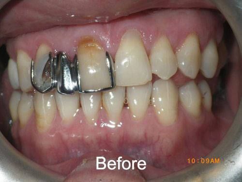 Before a Dental Bridge