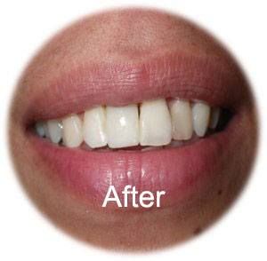 After a Dental Implant