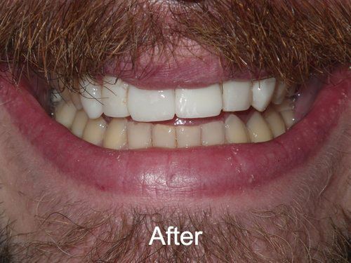 Patient After Veneers at Aurora Dental Care