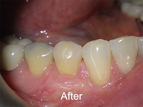 After Gum Grafts at Aurora Dental Care