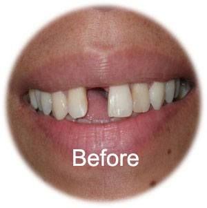 Patient Before A dental implant at Aurora Dental Care