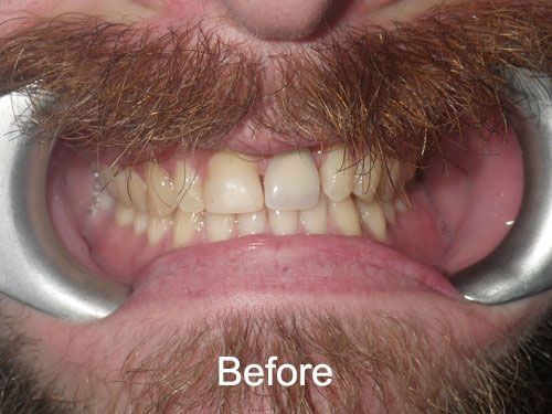 Patient Before veneers at Aurora Dental Care