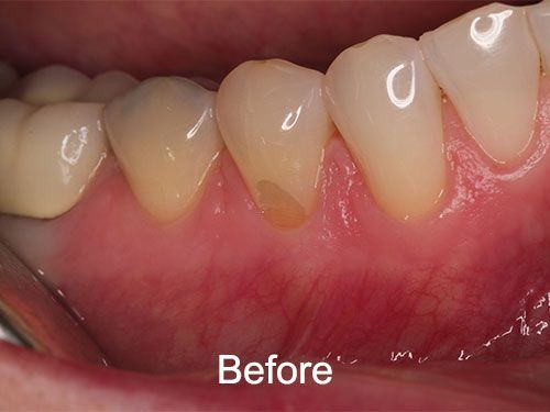 Before Gum Grafts at Aurora Dental Care