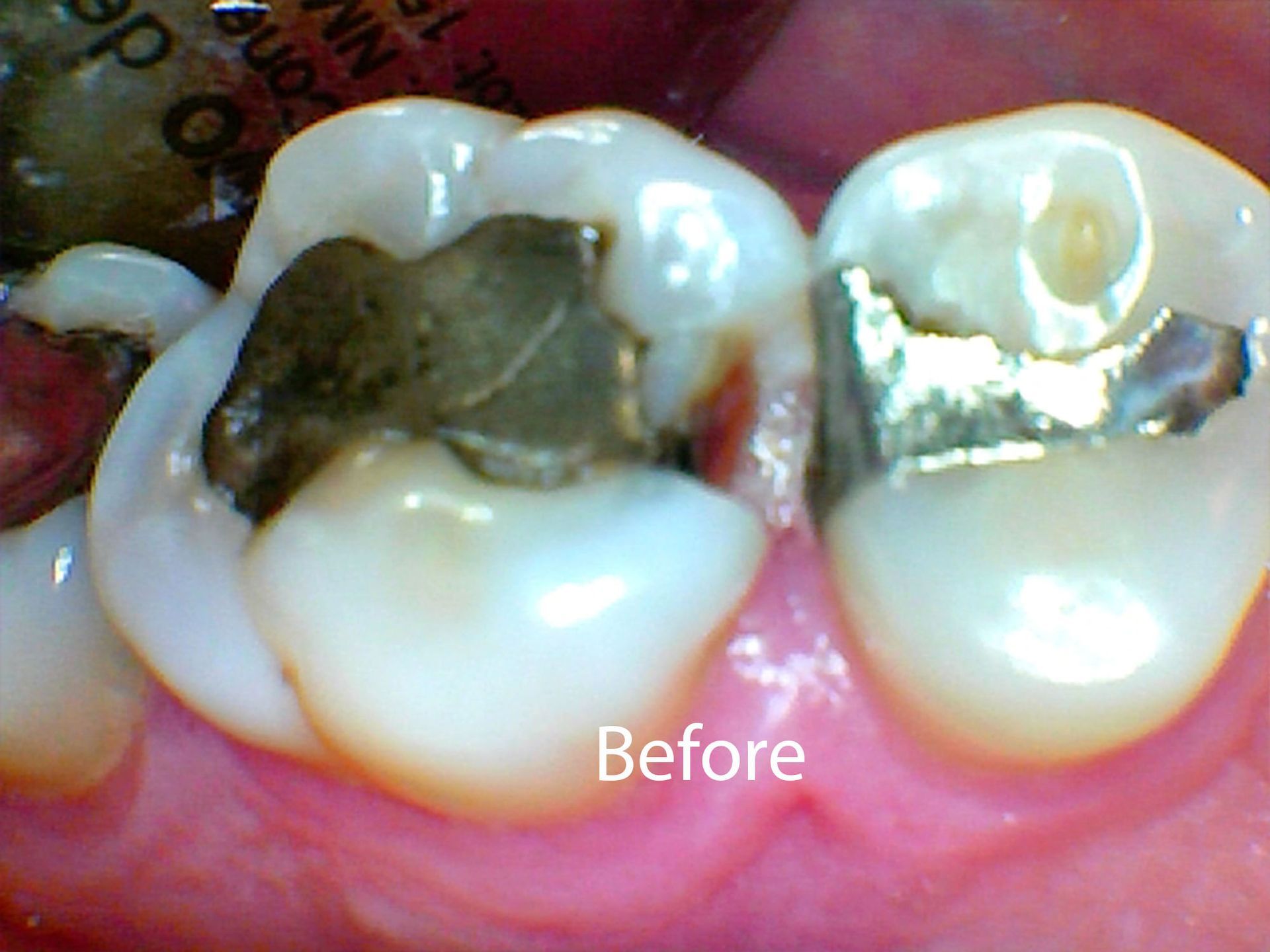 Patient Before crowns at Aurora Dental Care