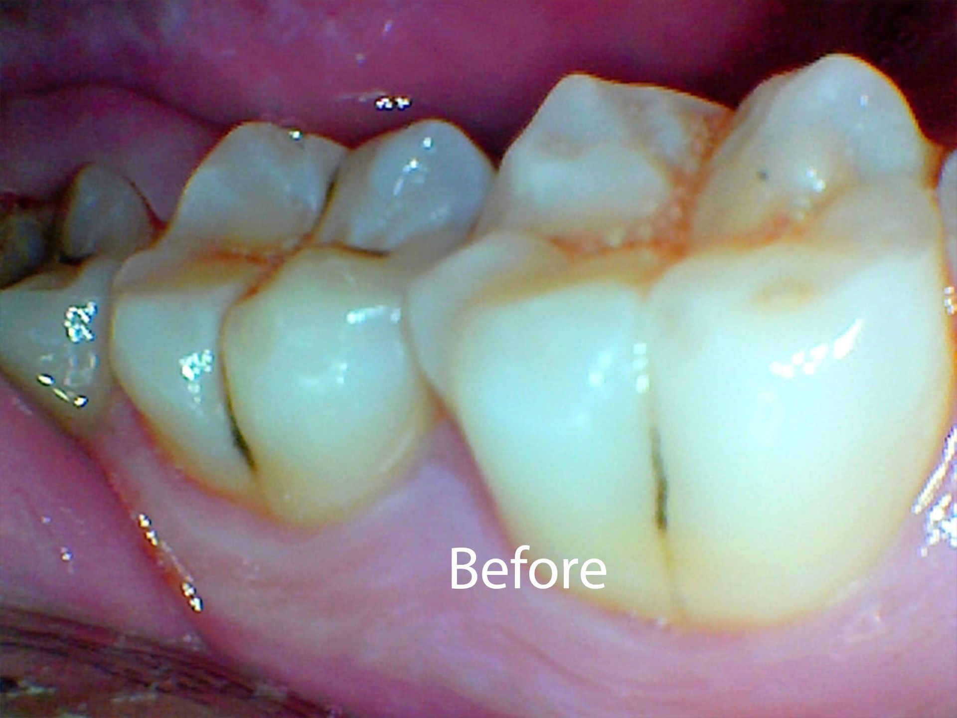 Before Fillings at Aurora Dental Care