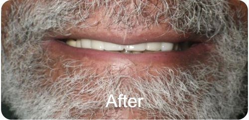 Patient after Dental Implant Bridge