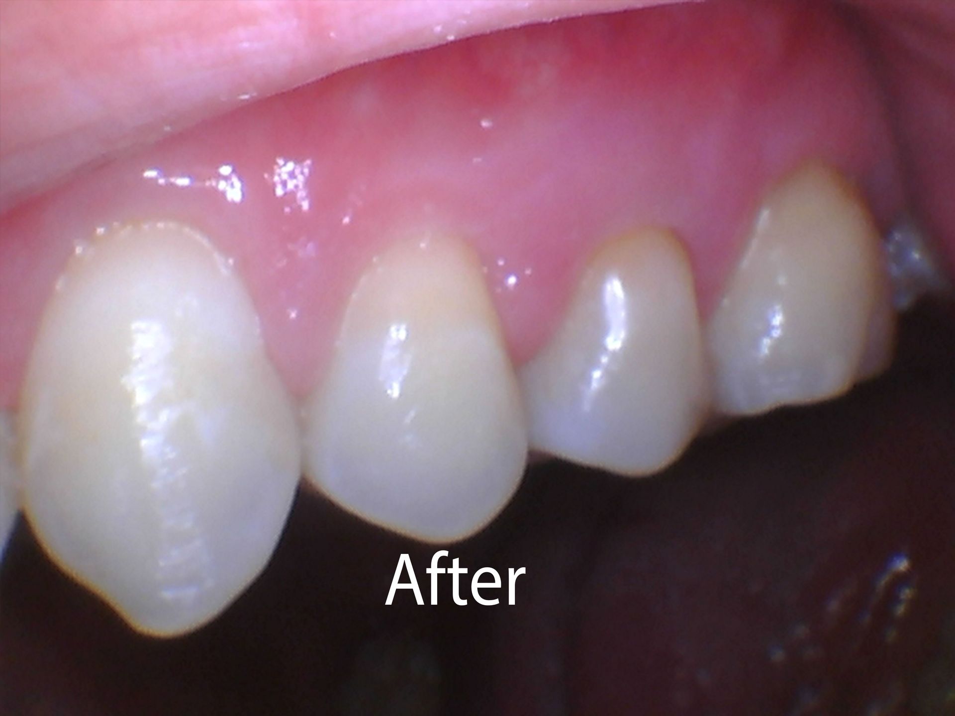 After a Gum Graft