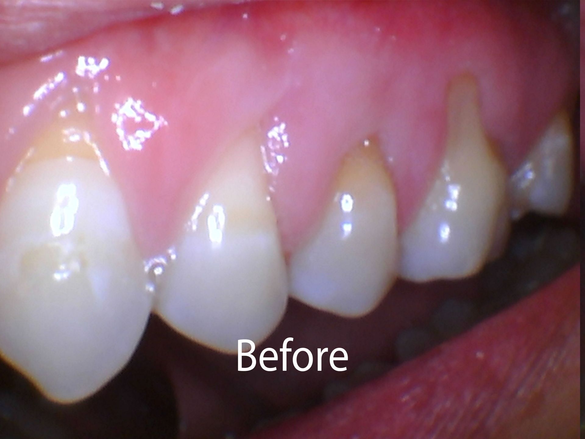 Before Gum Grafts at Aurora Dental Care