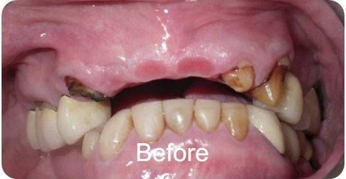 Before a Dental Implant Bridge