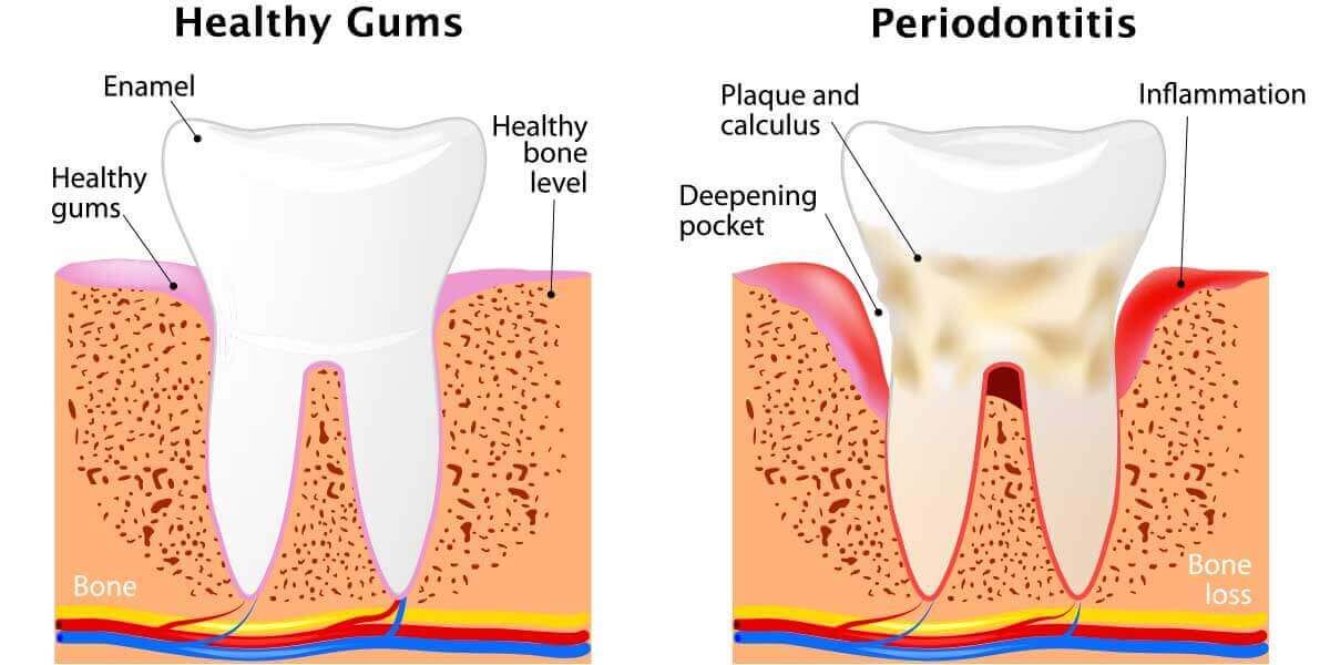 Healthy Gums vs Periodontitis