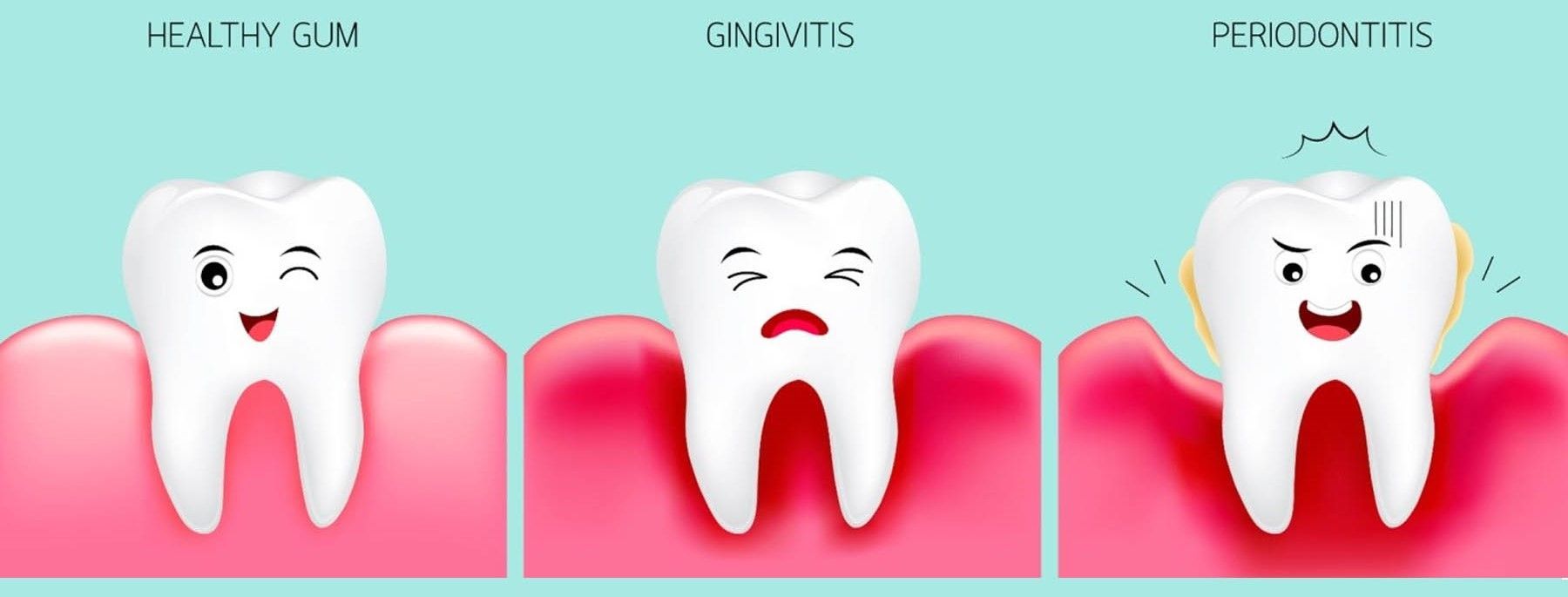 Gum pocket illustration