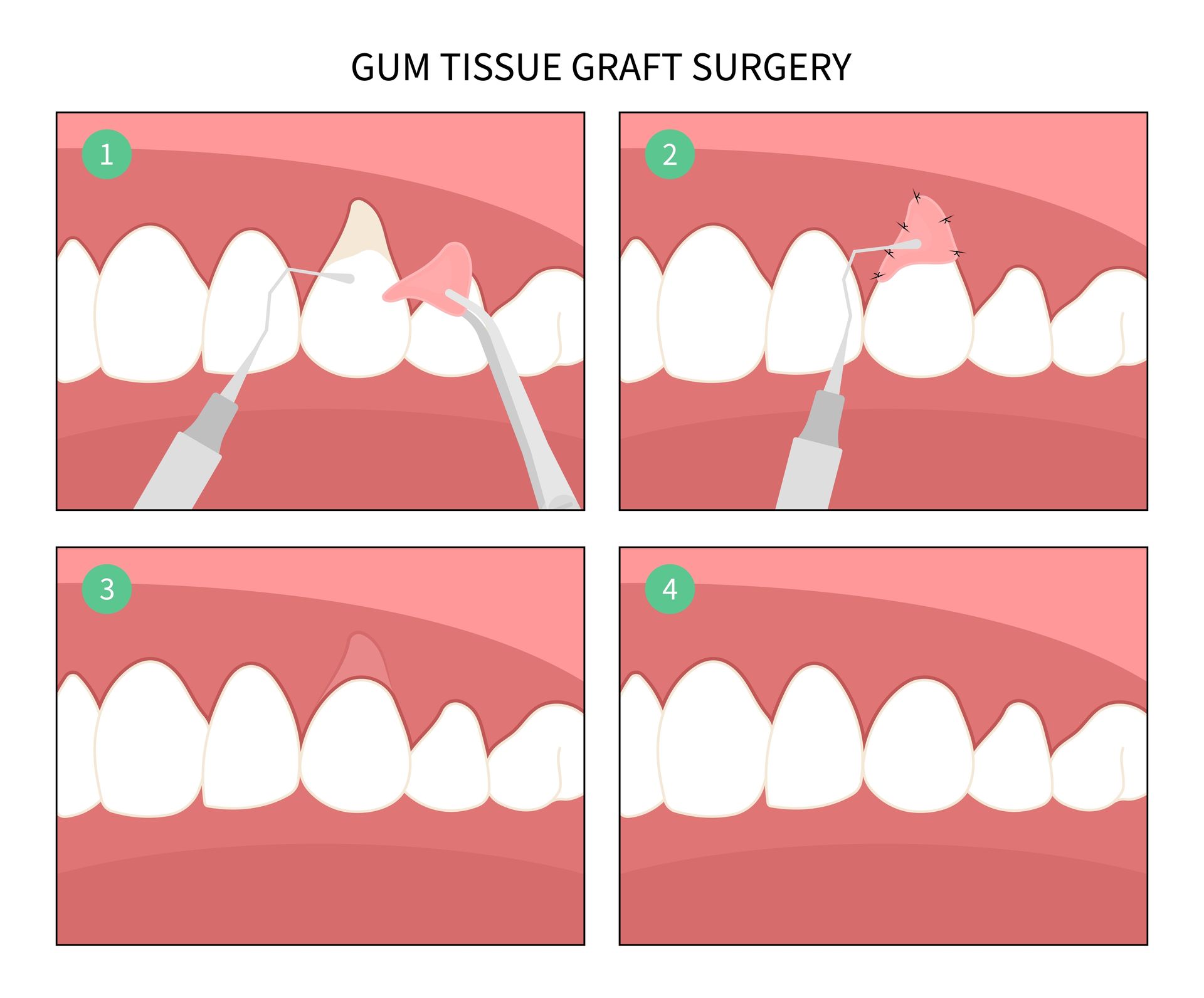 Seattle WA gum graft surgery